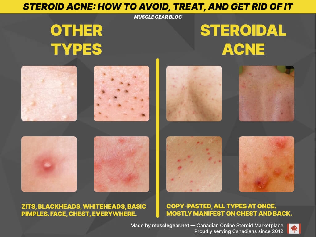 Infographics with visual comparison between steroid acne and other types of acne